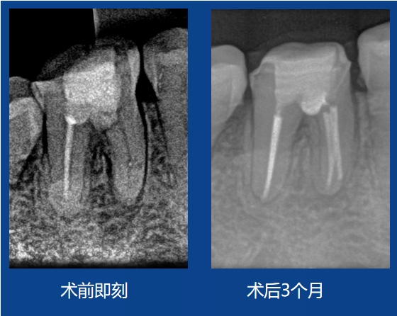 刘杰老师案例——髓室底穿孔修复