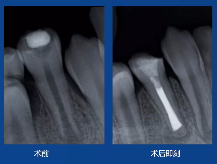 EduardoRamos 老师案例——根尖屏障术
