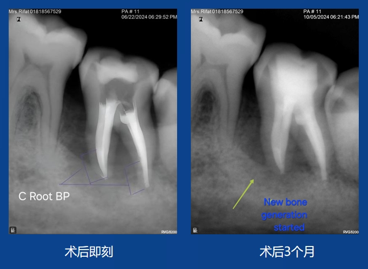 Sazzad Ur Rahman 老师案例——根吸收修复及充填
