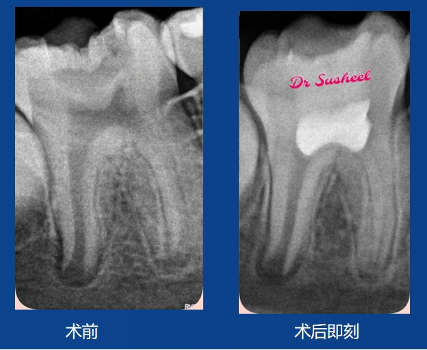 Susheel老师案例——活切直接盖髓